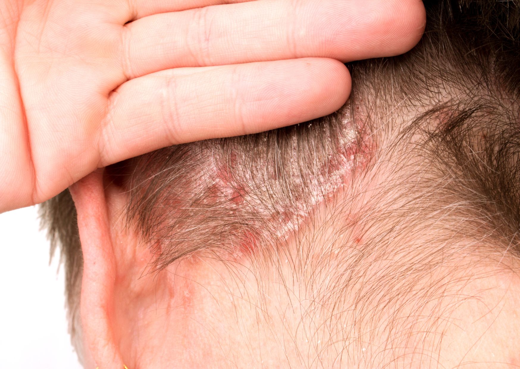 Dermatitis del cuero cabelludo: por qué empeora en invierno y cómo tratarla con un enfoque médico