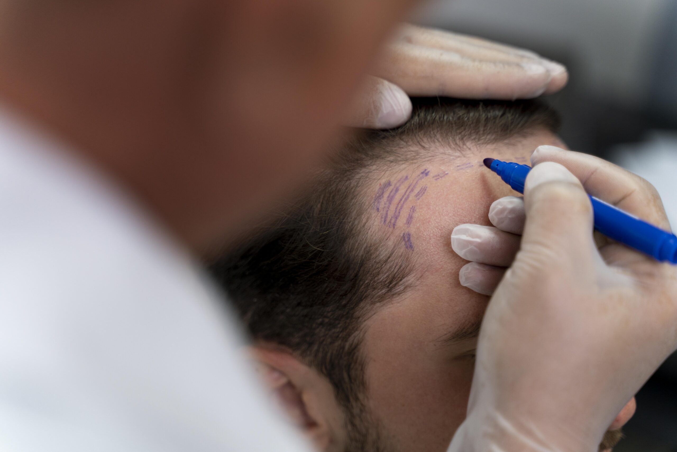 Microinjerto capilar: guía médica para preparar tu cuero cabelludo antes del procedimiento