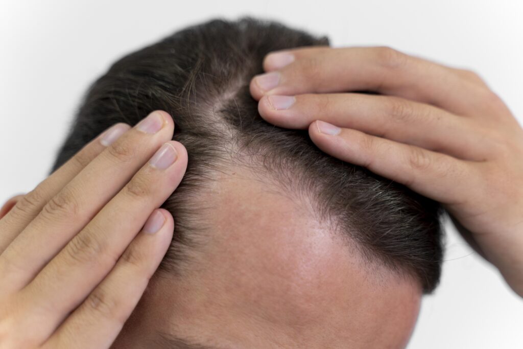 Si la alopecia está activa, lo ideal es estabilizarla con tratamientos médicos y terapias