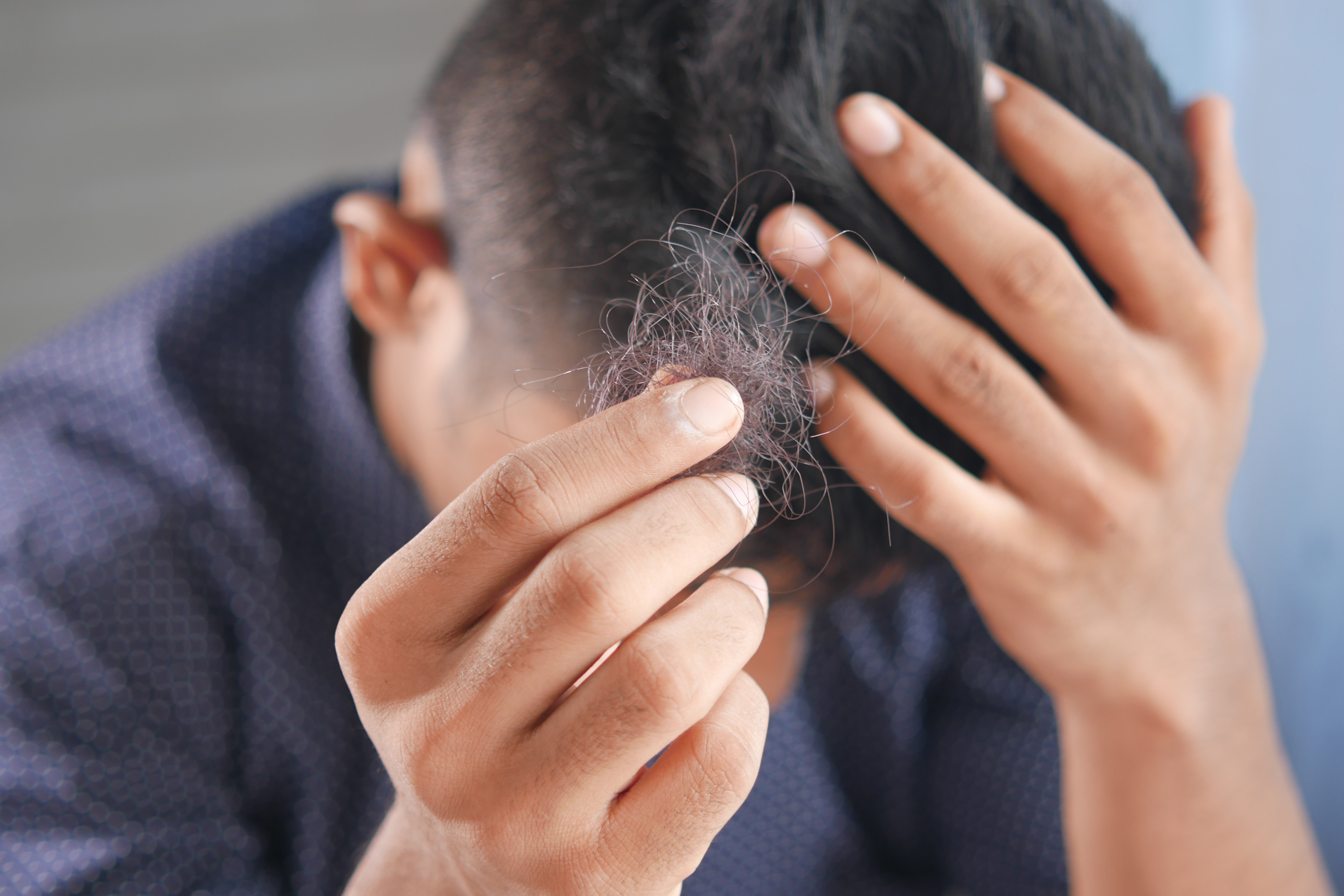Caída de cabello: ¿es normal perder más en invierno y cuándo debes consultar?
