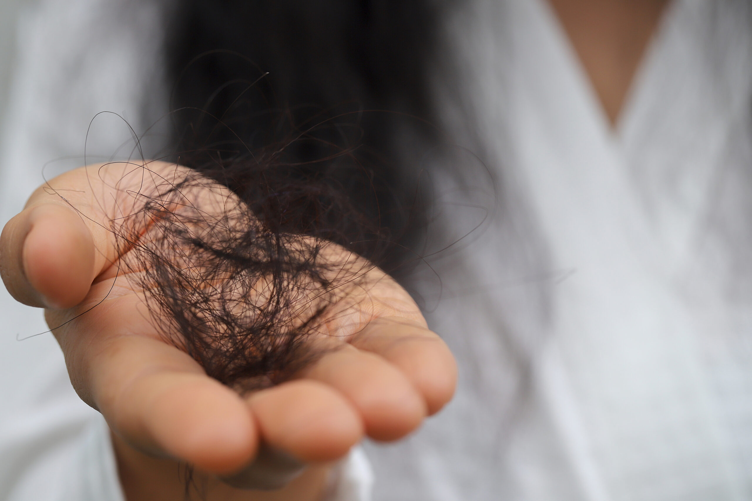 Caída por estrés: por qué ocurre y cómo se maneja médicamente para recuperar tu cabello