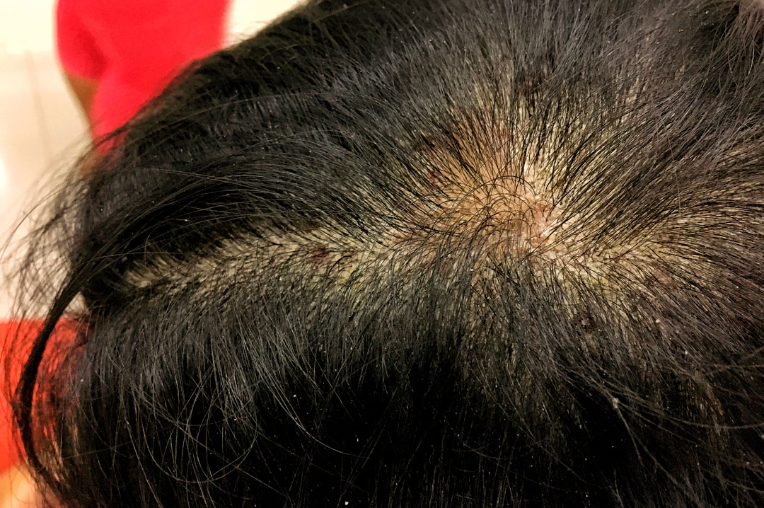 Dermatitis atópica del cuero cabelludo: causas, síntomas y cómo tratarla médicamente