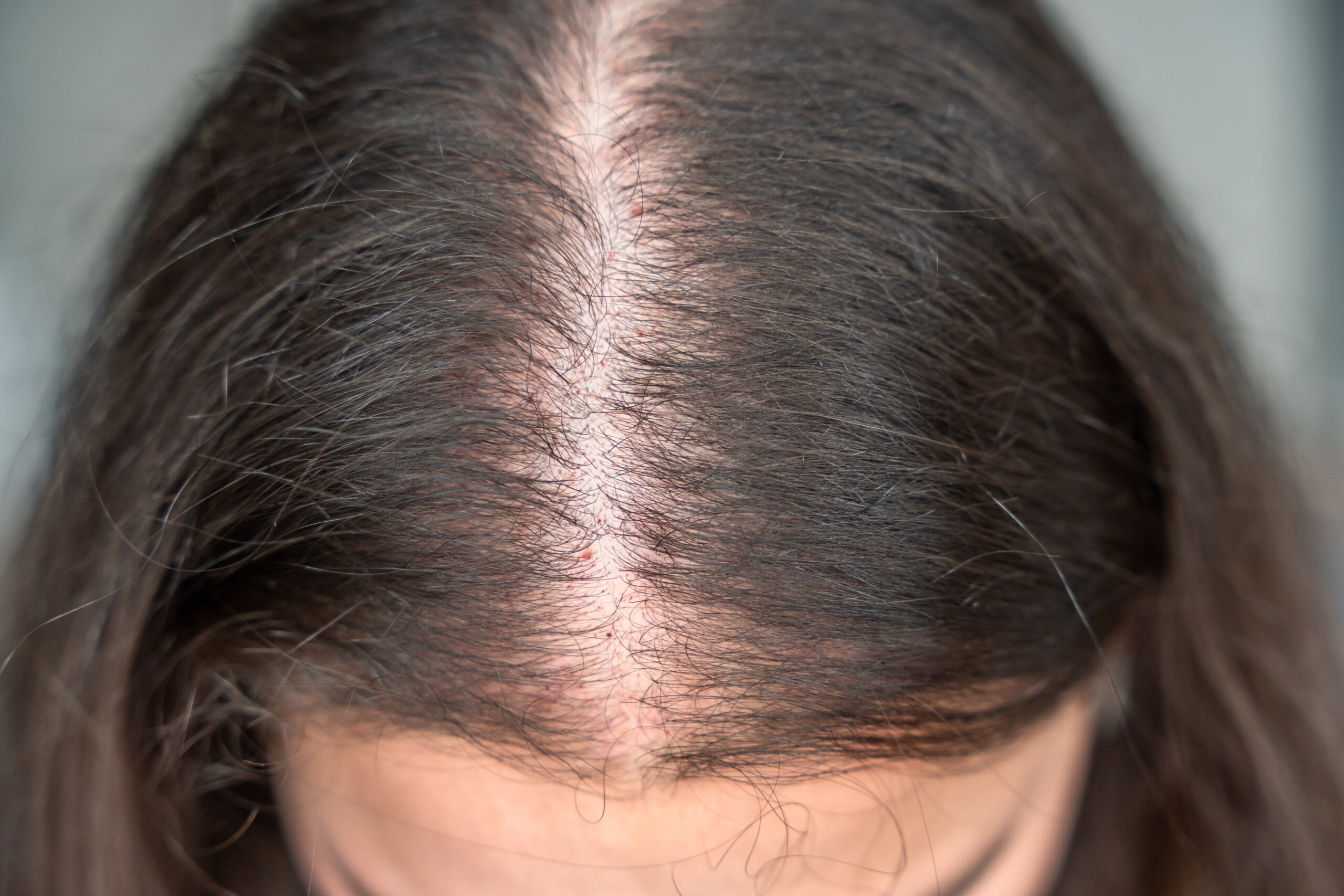 Alopecia androgenética: causas reales y cómo se trata clínicamente para frenar la caída y recuperar densidad
