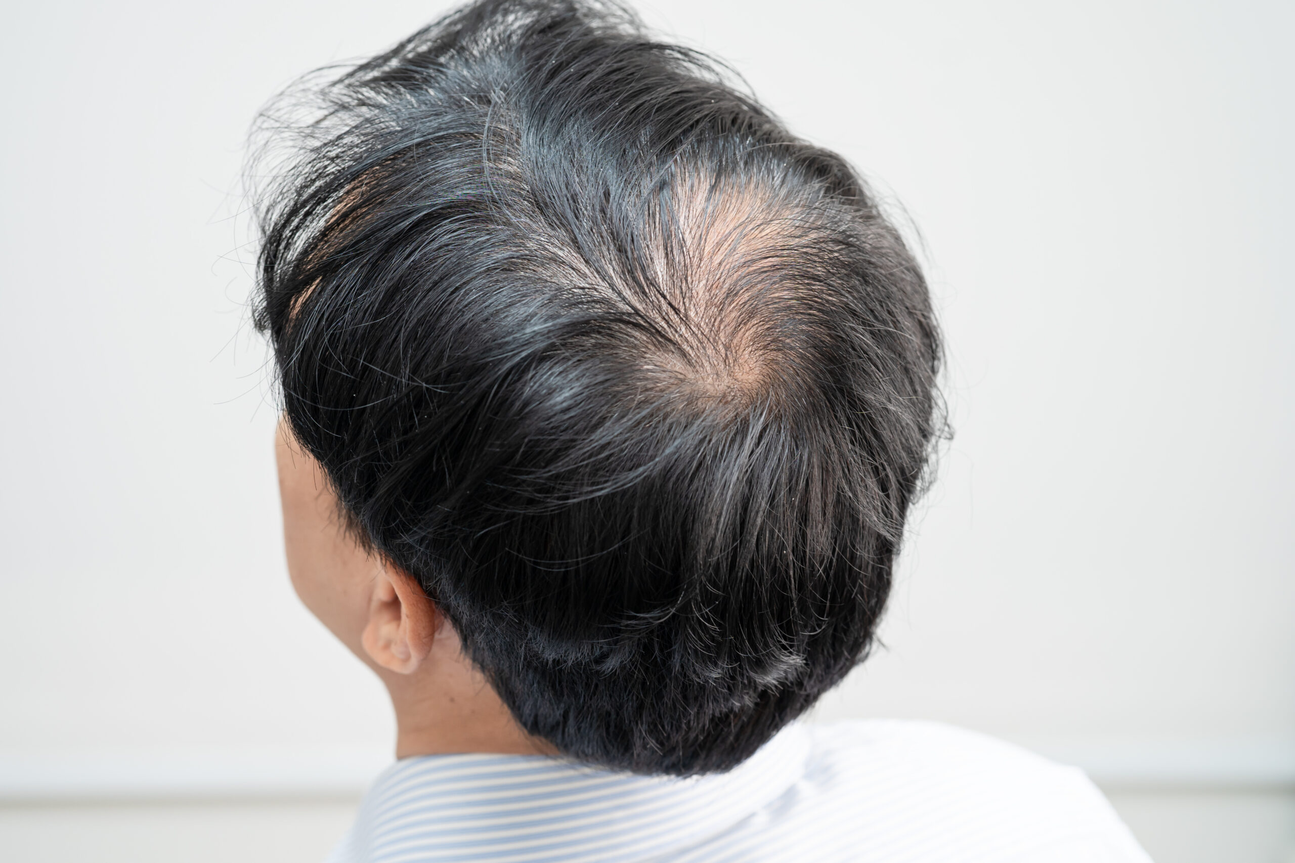 Alopecia: señales tempranas que nunca debes ignorar y que indican que necesitas un diagnóstico clínico