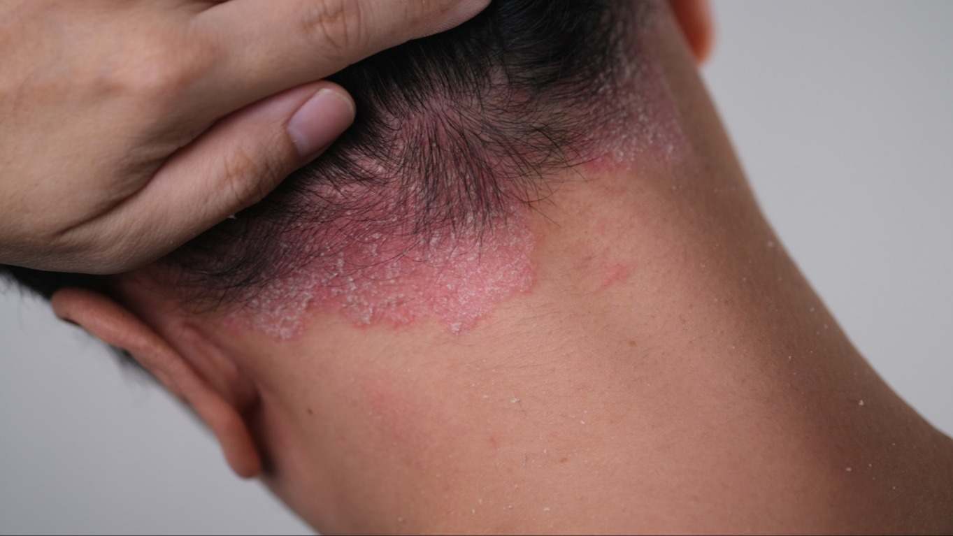 Dermatitis seborreica: cómo diferenciarla de la caspa común y cuál es el tratamiento médico ideal