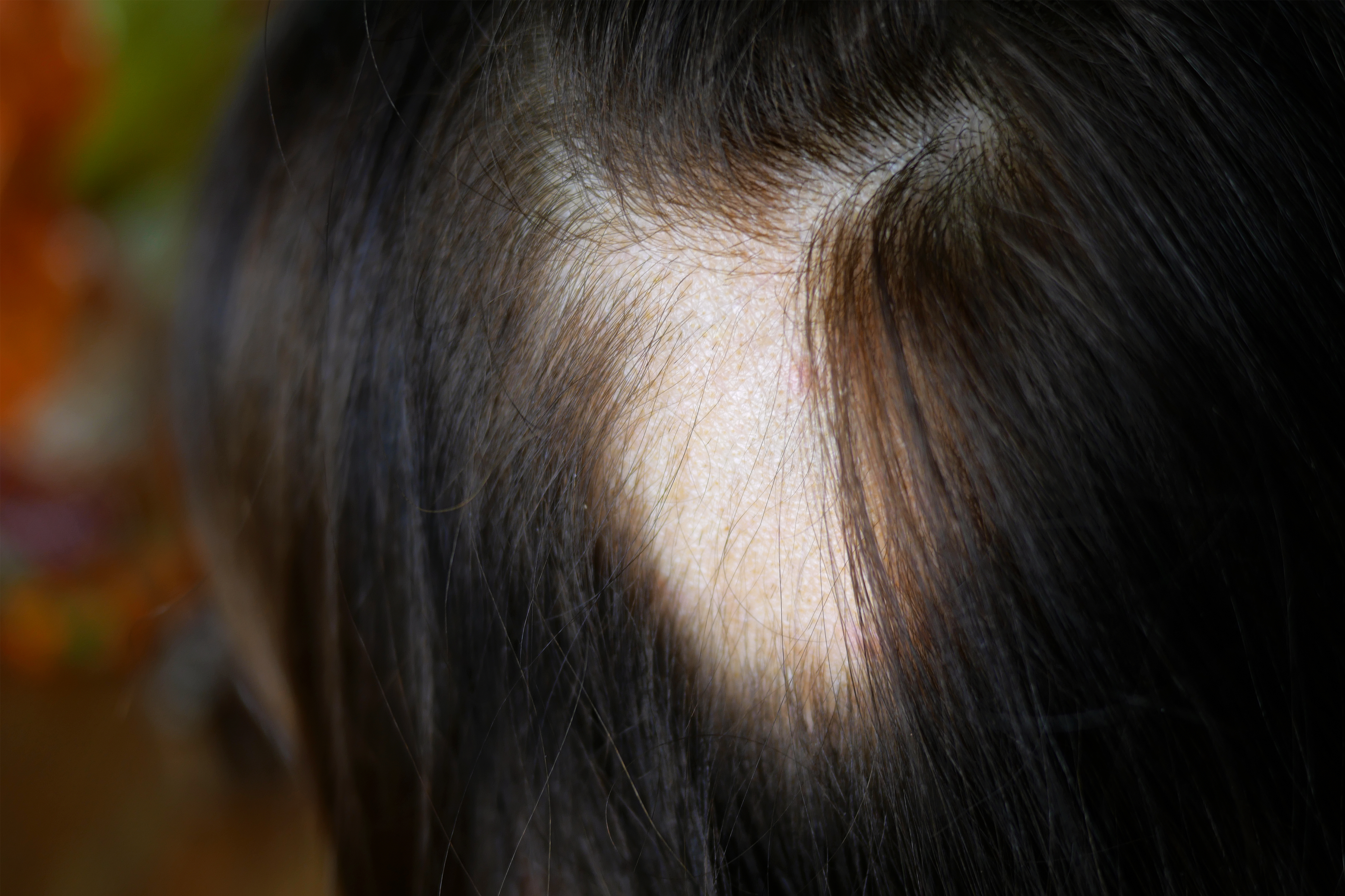 Alopecia areata: causas, diagnóstico y las opciones clínicas más efectivas para tratarla
