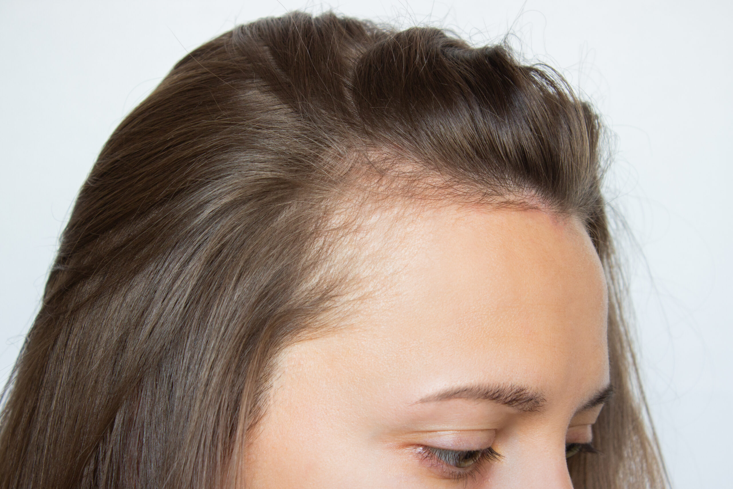 Alopecia femenina: por qué aumenta entre los 25 y 45 años y cuál es el tratamiento médico ideal