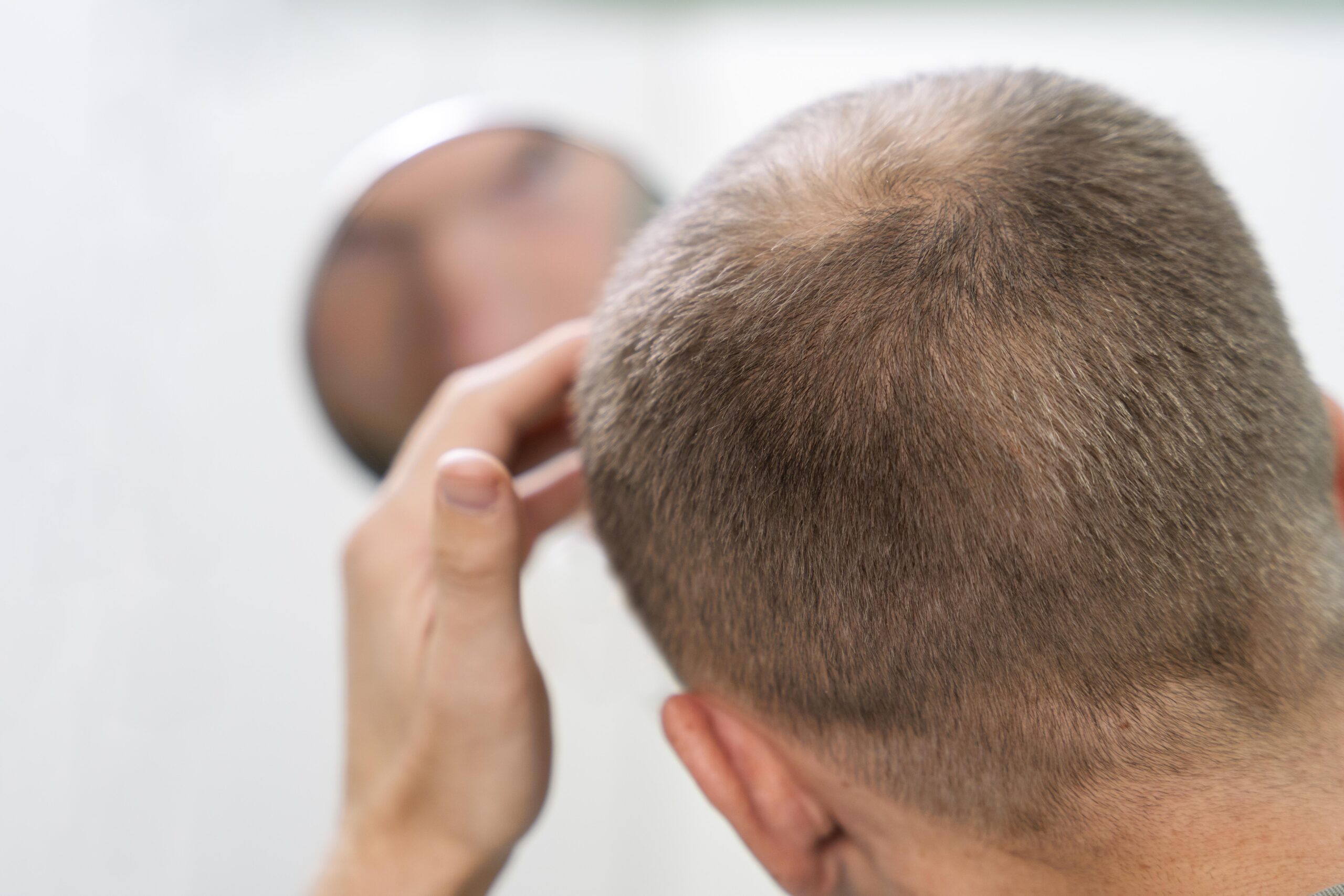 Alopecia androgenética masculina: señales tempranas y cuándo debes consultar a un especialista